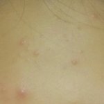 [댓글부탁해] <b>좁쌀</b>여드름없애는법ㅅㅂ제발플리즈