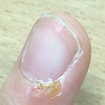 [드루와] 이거 손가락 <b>물집</b>이야?