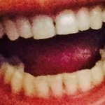 [읽어주세요] 치아교정 후기 전후사진 첨부