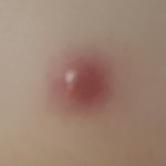 [EXO] 이거 여드름임??