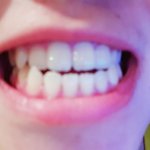 [조언부탁해] 혹시 부정<b>교합</b>때문에 양악하신분 있나요?