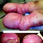 [공미니] [혐오] <b>부종</b> 걸린 발