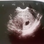 임신초기~~ 괜찮을까요??