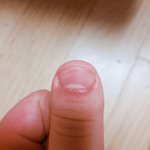 얘들아 내 <b>손톱</b> 기형? 그런 거라고 하던데