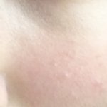 ( 약 극혐 )<b>홍조</b> 같아 ? ..