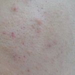 (씹극혐,환공포증주의)피부때문에 너무 스트레스야...도와줘......