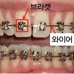 [개깊은빡침] 치아교정 피해사연 + 꿀팁,치과 선택 노하우 (1)