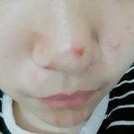 코 <b>피지</b> 짰는데 상처남