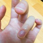 얘들아 나 큐티클제거하다 <b>이러</b>케됏는데 큐티클나랑안맞는거지?