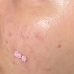 <b>좁쌀</b>여드름으로 고민하는 친구들에게