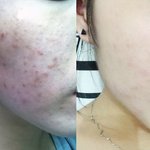 [피부관리] 프락셀 그런거 다 소용 없고, 홈케어가 최고다!