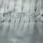 사랑니 <b>발치</b> 후기