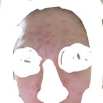 내 여드름 없애는 방법좀 알려주라ㅠㅠ(혐주의)