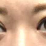 쌍수 후기 ( 짝눈 심함ㅠ )
