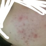 [드루와] 추가)혐주의)하루에 세개씩 나던 여드름 다 없애는 꿀팁...