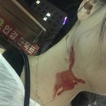 [꼭조언부탁] 목줄 없는 개로 인한 상해 보상 가능?(사진유)