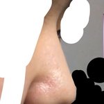 코<b>필러</b>맞앗뉸데 질문받음 사진추가
