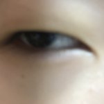 [조언부탁해] 약혐)오늘 쌍수했는데 붓기가 진심 너무<b>심해</b>..ㅜㅜㅜ