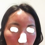 피부과 레이저 부작용으로 자살하고싶어요
