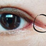 [쌍커풀절개] 절개쌍커풀 <b>흉터</b>?