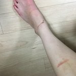 <b>장어집</b>에서 화상