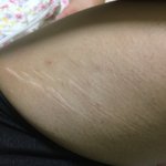 약혐주의) 허벅지 안 쪽 튼살