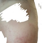 (혐) 여드름 때문에 스트레스가 심합니다