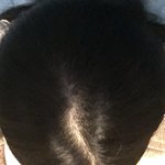 [댓글부탁해] 나 <b>탈모</b>온거 같은데