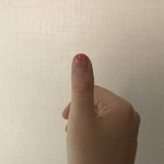 <b>엄지</b>손가락에 모기 물림ㅅㅂㅠㅠㅠㅠ