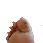 사진혐주의) 얘들아 뭐가 티눈이고 뭐가 사마귀야?