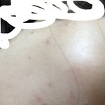 [제발제발제] 여드름 없애는 방법좀