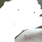 [10극혐] ㅁㅊ개큰일남 여드름<b>폭탄</b>임완전