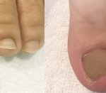 여드름 아토피 발톱<b>무좀</b>까지... 마유크림 소오름!!