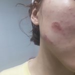 (약혐) 나 얼굴에 뭐가 났는데 <b>레알</b> 개이상해