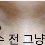 [드루와] 쌍수랑 트임한지 2주째야! 다 물어봐!!