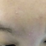얘들아 <b>이마에</b> 여드름 조카많이남 ㅅㅂ
