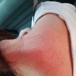 [개깊은빡침] 병원에서 <b>물리</b>치료후 화상입었는데요.