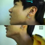 [방탄소년단] 여드름이 아니라 <b>종양</b>인가