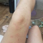[댓글부탁해] 바디워시만 쓰면 붉은<b>반점</b>?생기는데(사진ㅇ