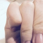 사진)손가락 <b>금</b> 갔었는데 이거 이상있는거야??