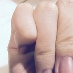 손가락 <b>금</b>갔던데가 아프면 어떡해??