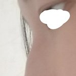 얘들아 나 <b>코끝</b> 자가연골 수술 할까