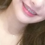 진짜 교정해 <b>입매</b> 확실히 달라짐b