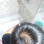탈모걸린 20대 남성