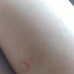 [댓글부탁해] 모기물린데 <b>진물</b>존1나큰데 이거어떡하냐??