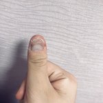 손톱이랑 그 주위 계속 뜯는 버릇 고치는 법좀..(<b>사진</b> <b>O</b> 약혐)