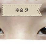 [드루와] 쌍수<b>하셈</b> (전후 사진 o)