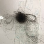 혐오사진일수도있음) 머리 이정도로 빠지는거 탈모인가요?