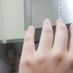 [조언부탁해] 호떡만들다가 화상입었는데