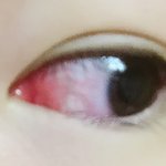 이거 결막염인지 봐주라ㅠㅠ